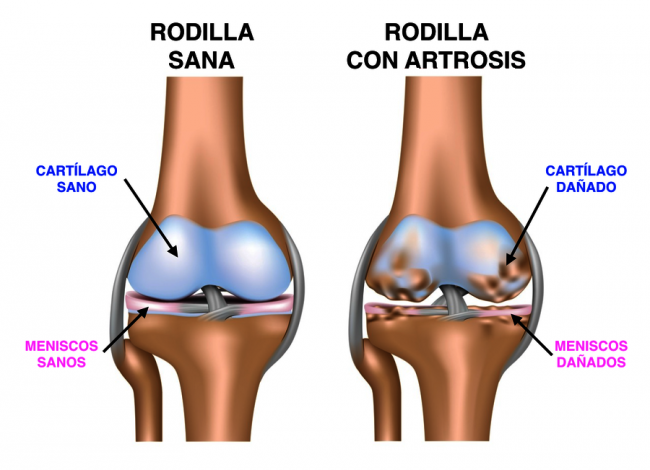 artrosis de rodilla