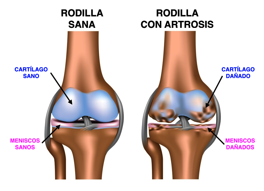 Cómo curar la artrosis de rodilla