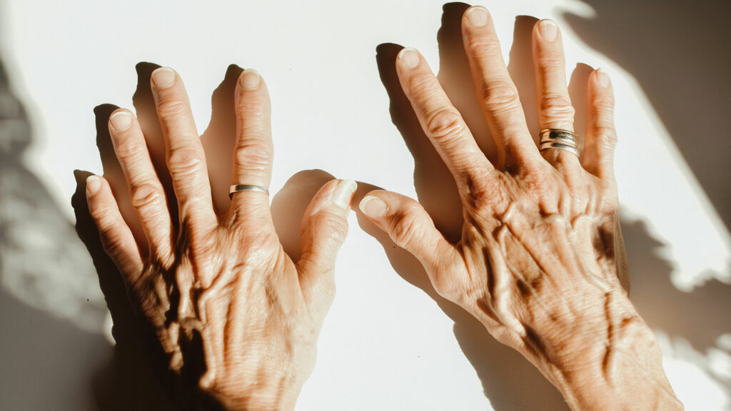 Reuma en las manos - Residencia de ancianos Ciudad Jardin