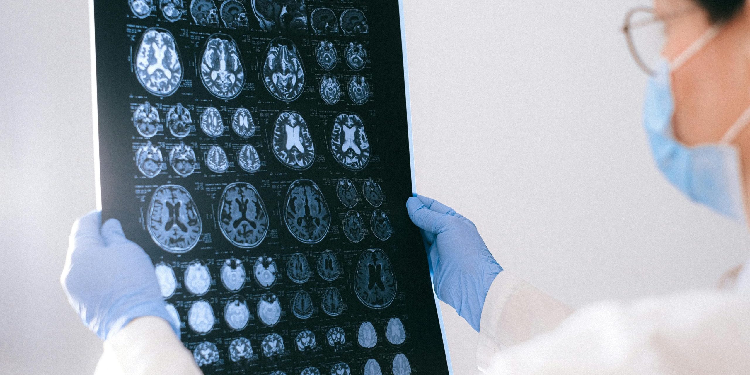 fases-del-alzheimer