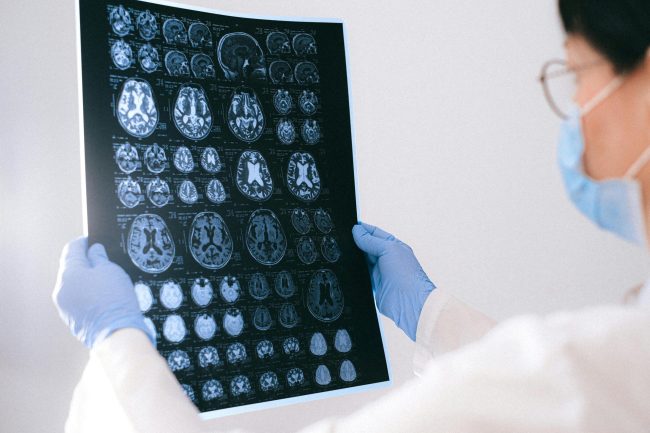 fases-del-alzheimer